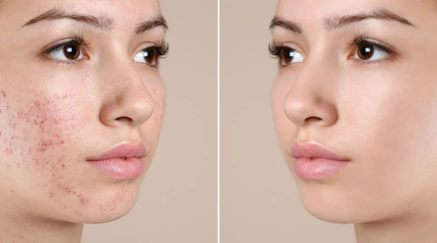 Acne Treatment: Best Solutions for Clear Skin at M Aesthetics by Dr. Akshay Mirajkar in Baner Pune, Karad, Satara